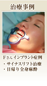 インプラント体験談